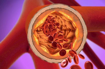 降血脂最快的方法 推荐5种健康降血脂的方法
