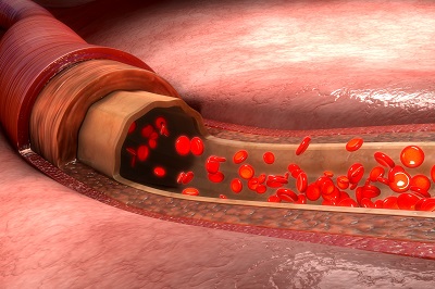 长期吃一物清血栓